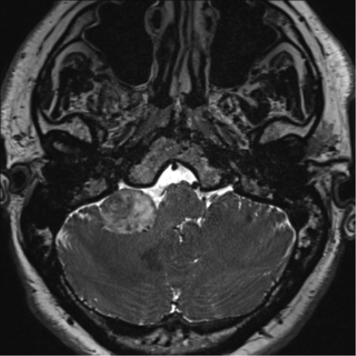 File:Acoustic schwannoma (Radiopaedia 50846-56358 Axial T2 10).png