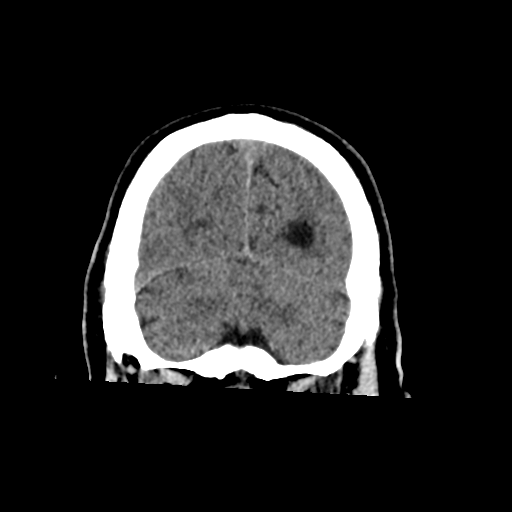 File:Acoustic schwannoma (Radiopaedia 55729-62280 Coronal non-contrast 34).png