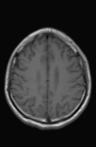 Acoustic schwannoma - probable (Radiopaedia 20386-20292 Axial T1 14).jpg