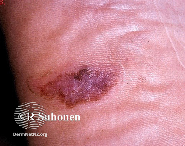 File:Acral lentignous melanoma (DermNet NZ lesions-melanoma-s-alm4).jpg