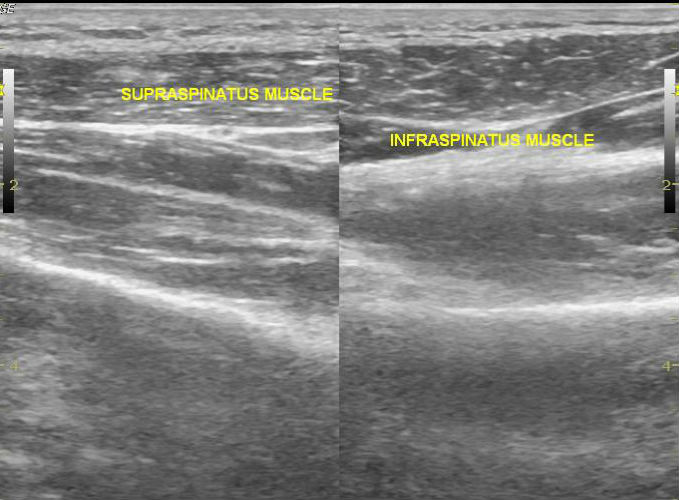 File:Acromial fracture - ultrasound (Radiopaedia 26729-26891 I 1).jpg