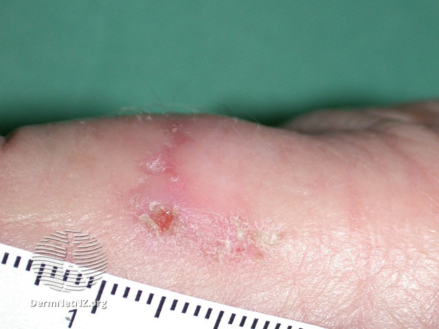 File:Actinic keratoses affecting the hands (DermNet NZ lesions-ak-hands-521).jpg