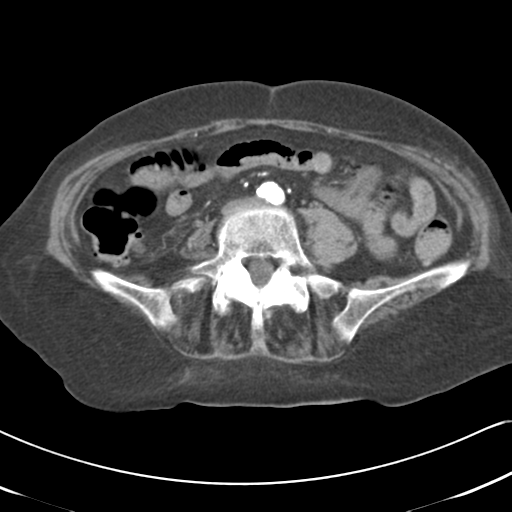 File:Active bleeding from duodenal ulcer with embolization (Radiopaedia 34216-35481 Axial C+ arterial phase 39).png