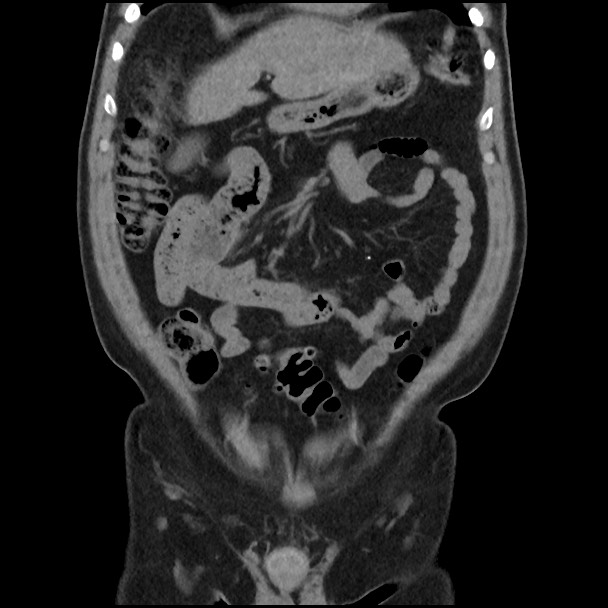 Active colonic bleed on CT (Radiopaedia 49765-55025 Coronal non-contrast 17).jpg