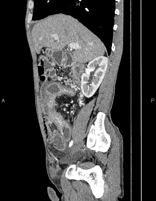 Active crohn disease (Radiopaedia 87133-103397 Sagittal C+ arterial phase 28).jpg