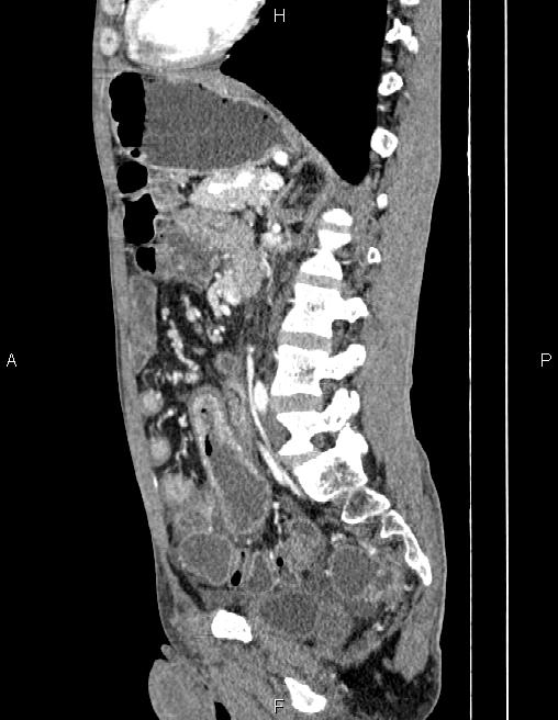 Active crohn disease (Radiopaedia 87133-103397 Sagittal C+ arterial phase 54).jpg