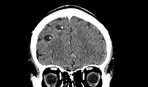 File:Active neurocysticercosis before and after therapy (Radiopaedia 71710-82099 Coronal 45).jpg