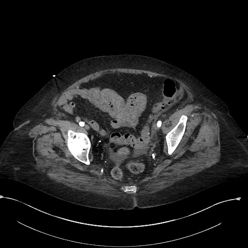 File:Active renal extravasation with large subcapsular and retroperitoneal hemorrhage (Radiopaedia 60975-68796 Axial C+ arterial phase 170).jpg