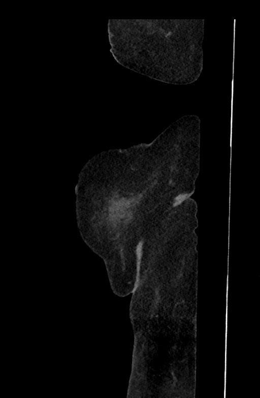 Active renal extravasation with large subcapsular and retroperitoneal hemorrhage (Radiopaedia 60975-68796 Sagittal C+ portal venous phase 216).jpg