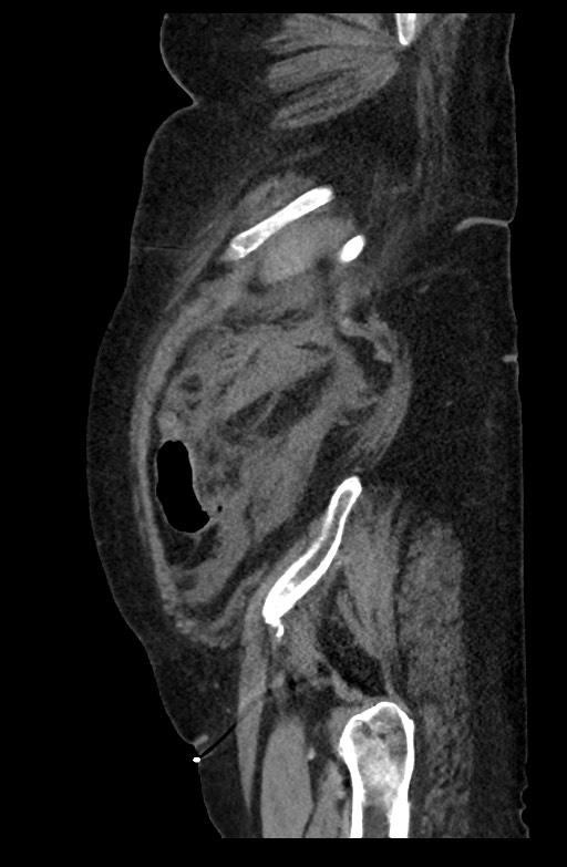 Active renal extravasation with large subcapsular and retroperitoneal hemorrhage (Radiopaedia 60975-68796 Sagittal C+ portal venous phase 52).jpg