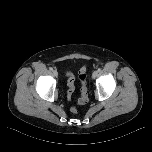 Acute-on-chronic pancreatitis (Radiopaedia 67286-76656 Axial C+ portal venous phase 74).jpg