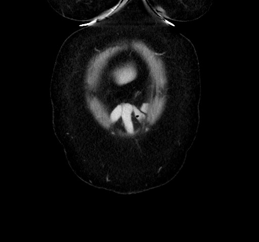 Acute appendicitis, heterotaxy syndrome (Radiopaedia 66884-76202 Coronal C+ portal venous phase 7).jpg