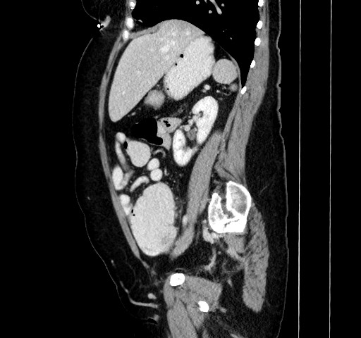 Acute appendicitis, heterotaxy syndrome (Radiopaedia 66884-76202 Sagittal C+ portal venous phase 53).jpg
