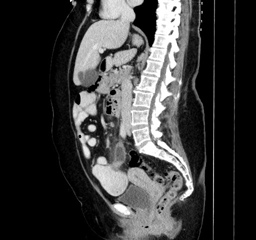 Acute appendicitis, heterotaxy syndrome (Radiopaedia 66884-76202 Sagittal C+ portal venous phase 67).jpg