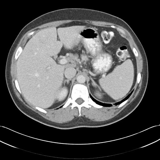 File:Acute appendicitis (Radiopaedia 30297-30934 Axial C+ portal venous phase 20).jpg