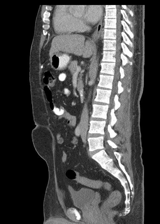 Acute appendicitis (Radiopaedia 48511-53463 Sagittal C+ portal venous phase 71).jpg