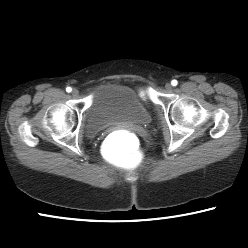 File:Acute appendicitis (Radiopaedia 52672-58589 Axial C+ arterial phase 34).jpg