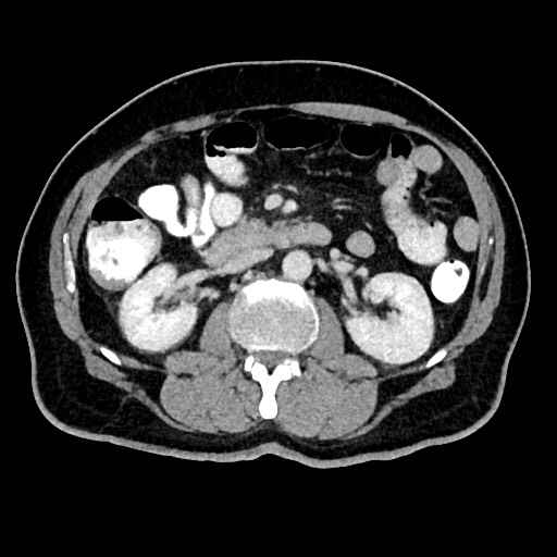 Acute appendicitis (Radiopaedia 77016-88960 Axial C+ portal venous phase 63).jpg