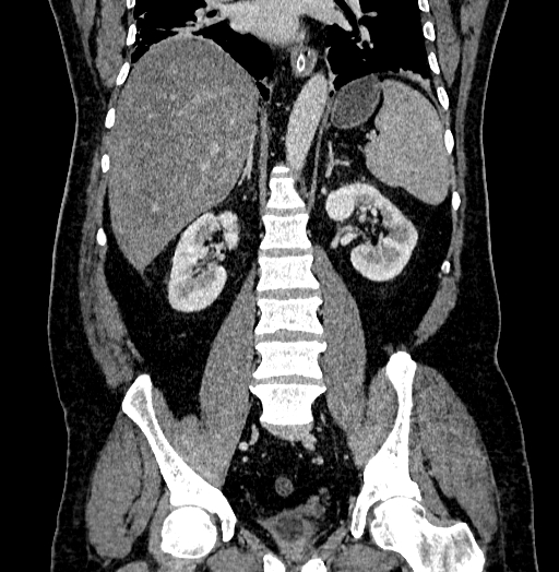 Acute appendicitis (Radiopaedia 79950-93224 Coronal C+ portal venous phase 59).jpg