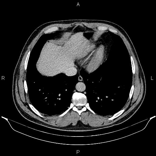 File:Acute appendicitis (Radiopaedia 84780-100240 Axial C+ portal venous phase 10).jpg