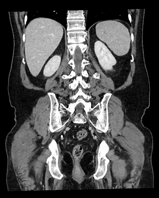Acute appendicitis - large appendicoliths (Radiopaedia 61805-69820 Coronal C+ portal venous phase 99).jpg
