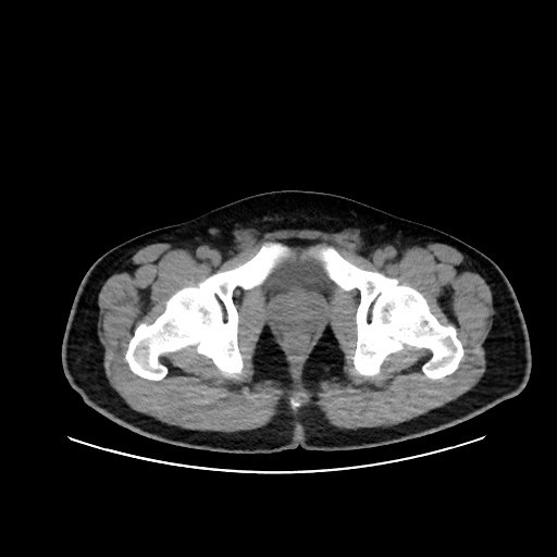 Acute appendicitis and COVID 19 pneumonia (Radiopaedia 76604-88380 Axial non-contrast 120).jpg