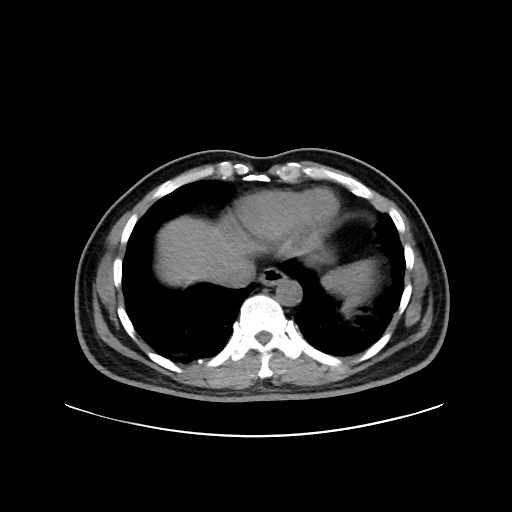 Acute appendicitis and COVID 19 pneumonia (Radiopaedia 76604-88380 Axial non-contrast 44).jpg