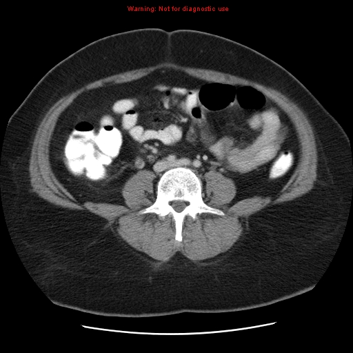 Acute appendicitis complicated by ovarian vein thrombophlebitis (Radiopaedia 16172-15851 Axial C+ portal venous phase 57).jpg