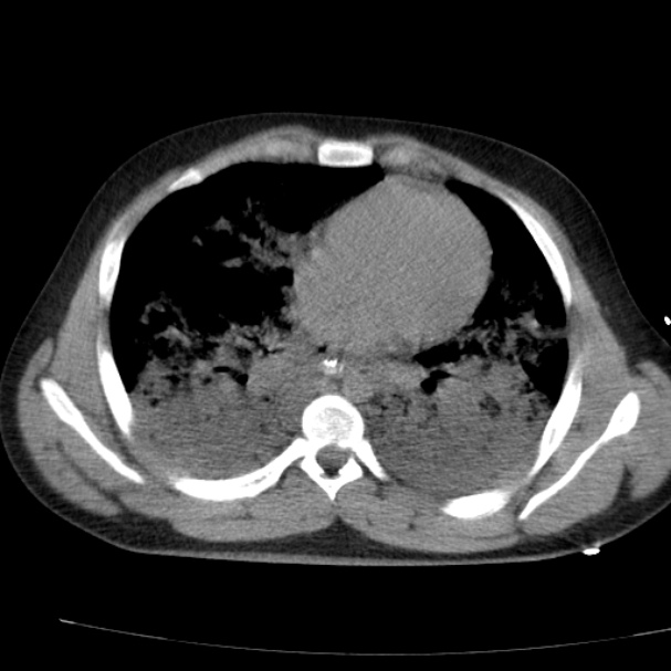 Acute aspiration pneumonitis (Radiopaedia 33605-34703 Axial non-contrast 54).jpg