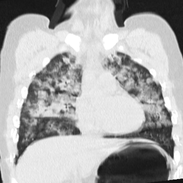 Acute aspiration pneumonitis (Radiopaedia 33605-34703 Coronal lung window 34).jpg