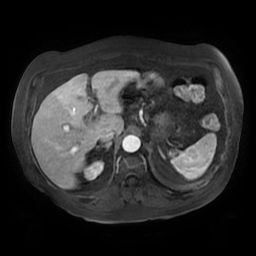 Acute cholecystitis complicated by pylephlebitis (Radiopaedia 65782-74915 Axial arterioportal phase T1 C+ fat sat 42).jpg