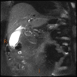File:Acute cholecystitis with gallbladder neck calculus (Radiopaedia 42795-45971 Coronal T2 Half-fourier-acquired single-shot turbo spin echo (HASTE) 8).jpg