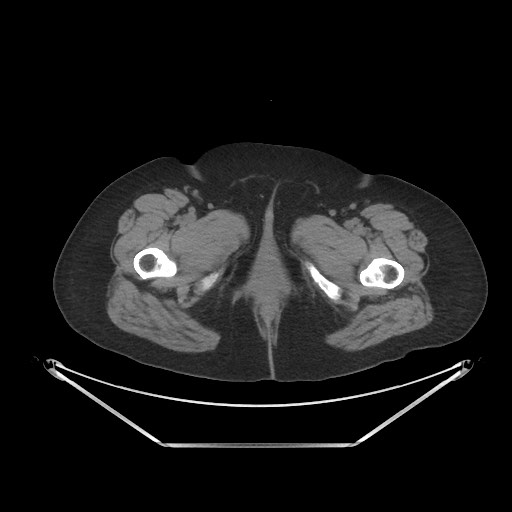 File:Acute cholecystitis with tensile fundus sign (Radiopaedia 71394-81723 Axial non-contrast 132).jpg