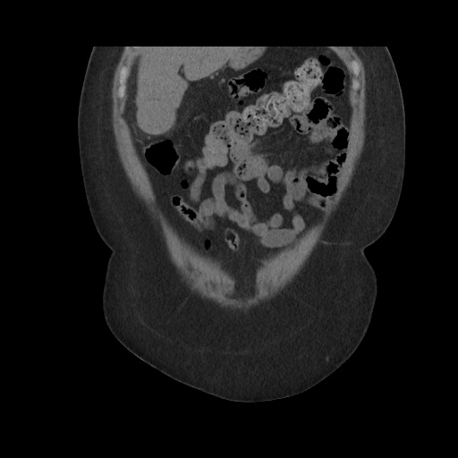 Acute cholecystitis with tensile fundus sign (Radiopaedia 71394-81723 Coronal non-contrast 35).jpg