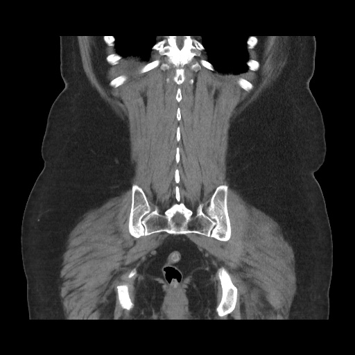 Acute cholecystitis with tensile fundus sign (Radiopaedia 71394-81723 Coronal non-contrast 97).jpg