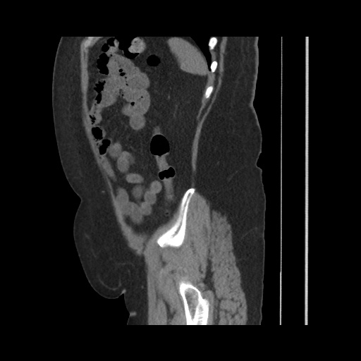 Acute cholecystitis with tensile fundus sign (Radiopaedia 71394-81723 Sagittal non-contrast 132).jpg