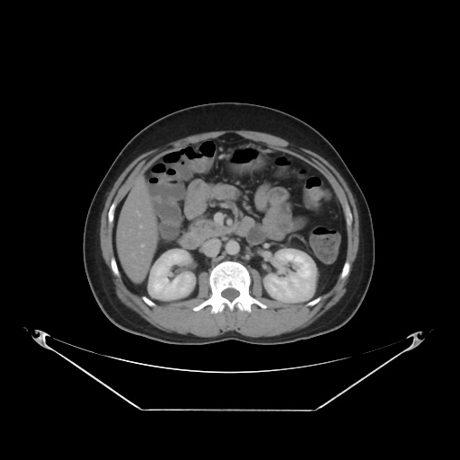 File:Acute complicated calculous cholecystitis (Radiopaedia 55202-61587 Axial C+ delayed 43).jpg