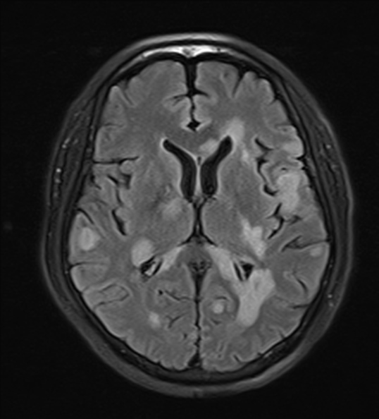 File:Acute disseminated encephalomyelitis (Radiopaedia 37253-39033 Axial FLAIR 15).jpg