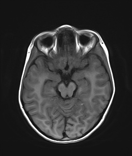 File:Acute disseminating encephalomyelitis with bilateral optic neuritis (Radiopaedia 79676-92886 Axial T1 10).jpg
