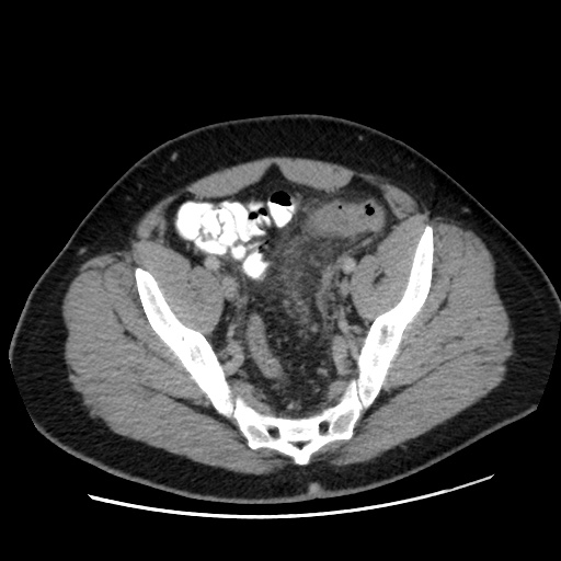 Acute diverticulitis with localized perforation (Radiopaedia 41296-44113 Axial C+ portal venous phase 75).jpg