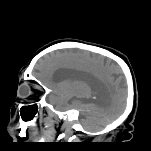File:Acute hemorrhagic stroke (Radiopaedia 17507-17223 Sagittal non-contrast 32).jpg