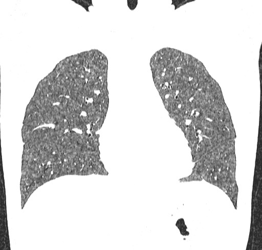 Acute hypersensitivity pneumonitis (Radiopaedia 85293-100870 Coronal lung window 45).jpg