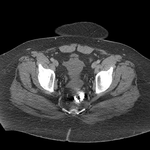Acute mesenteric venous ischemia (Radiopaedia 46041-50383 Axial C+ portal venous phase 129).jpg