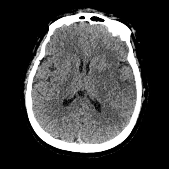 Acute middle cerebral artery territory infarct (Radiopaedia 52380-58283 Axial non-contrast 57).jpg