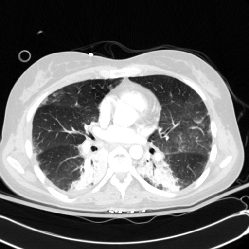 Acute myocardial infarction in CT (Radiopaedia 39947-42415 Axial lung window 69).jpg