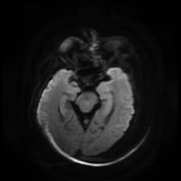 Acute otitis externa (Radiopaedia 57296-64236 Axial DWI 1).jpg
