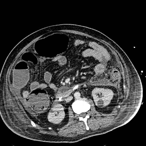 File:Acute pancreatic necrosis (Radiopaedia 13560-18501 Axial C+ portal venous phase 69).jpg