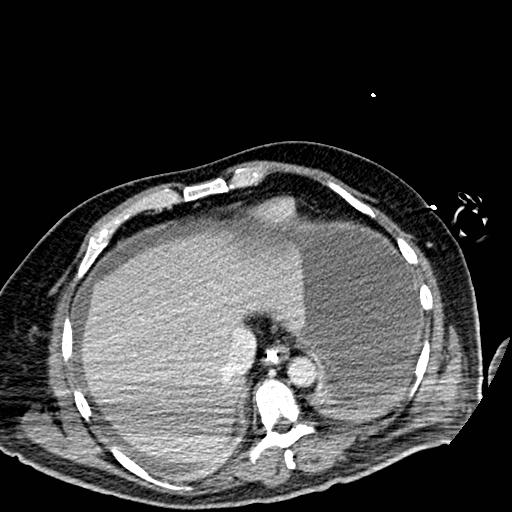Acute pancreatic necrosis (Radiopaedia 13560-18501 Axial C+ portal venous phase 8).jpg