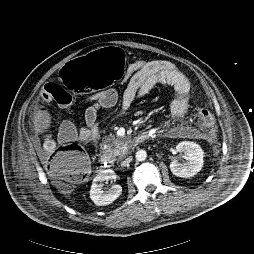 Acute pancreatic necrosis (Radiopaedia 13560-18502 Axial C+ portal venous phase 44).jpg