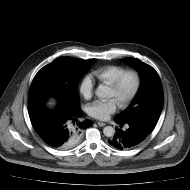 Acute pancreatitis (Radiopaedia 26663-26813 Axial C+ portal venous phase 2).jpg